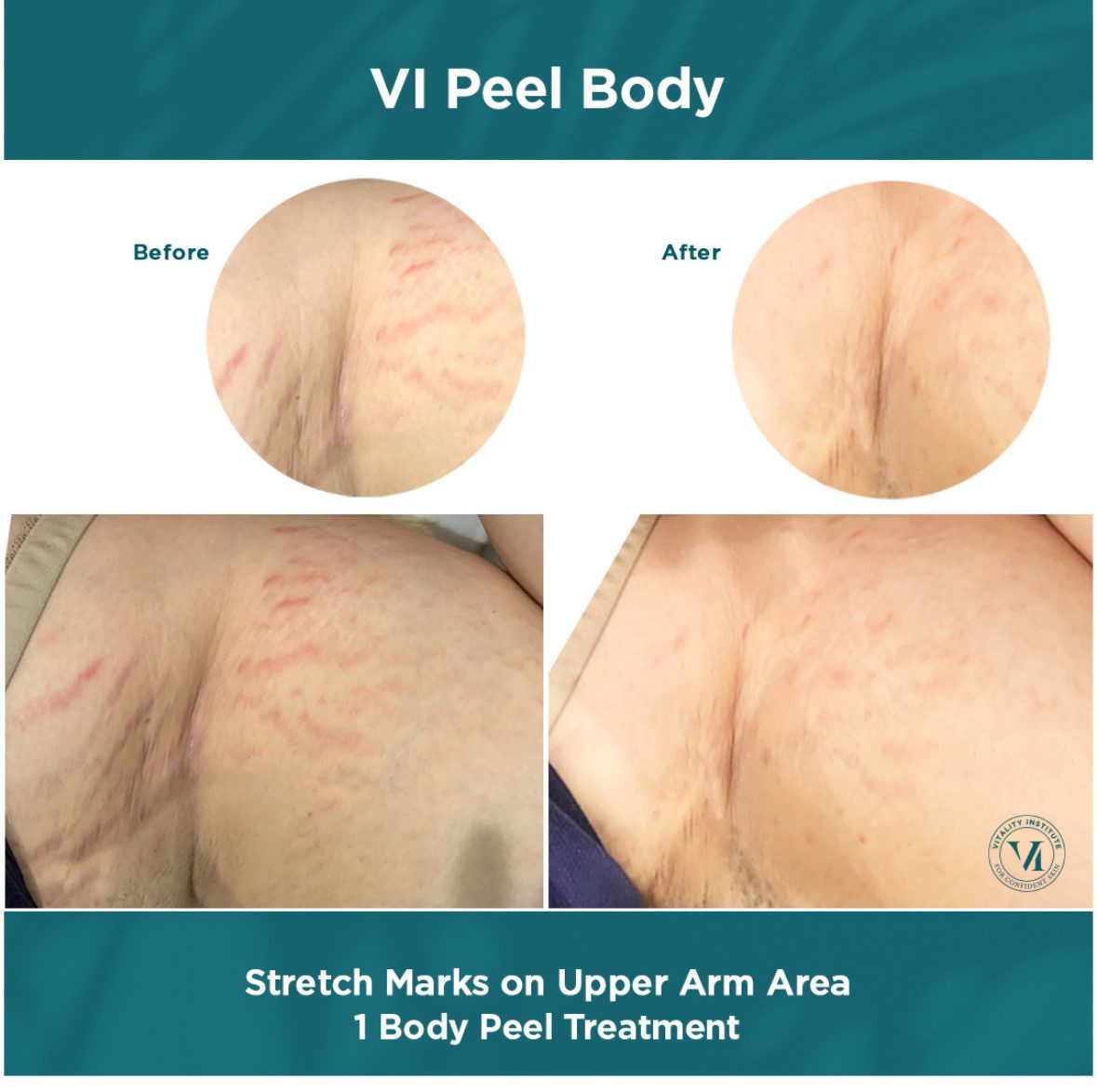 VI Peel at Glacial Lakes Aesthetics in Spicer, Minnesota