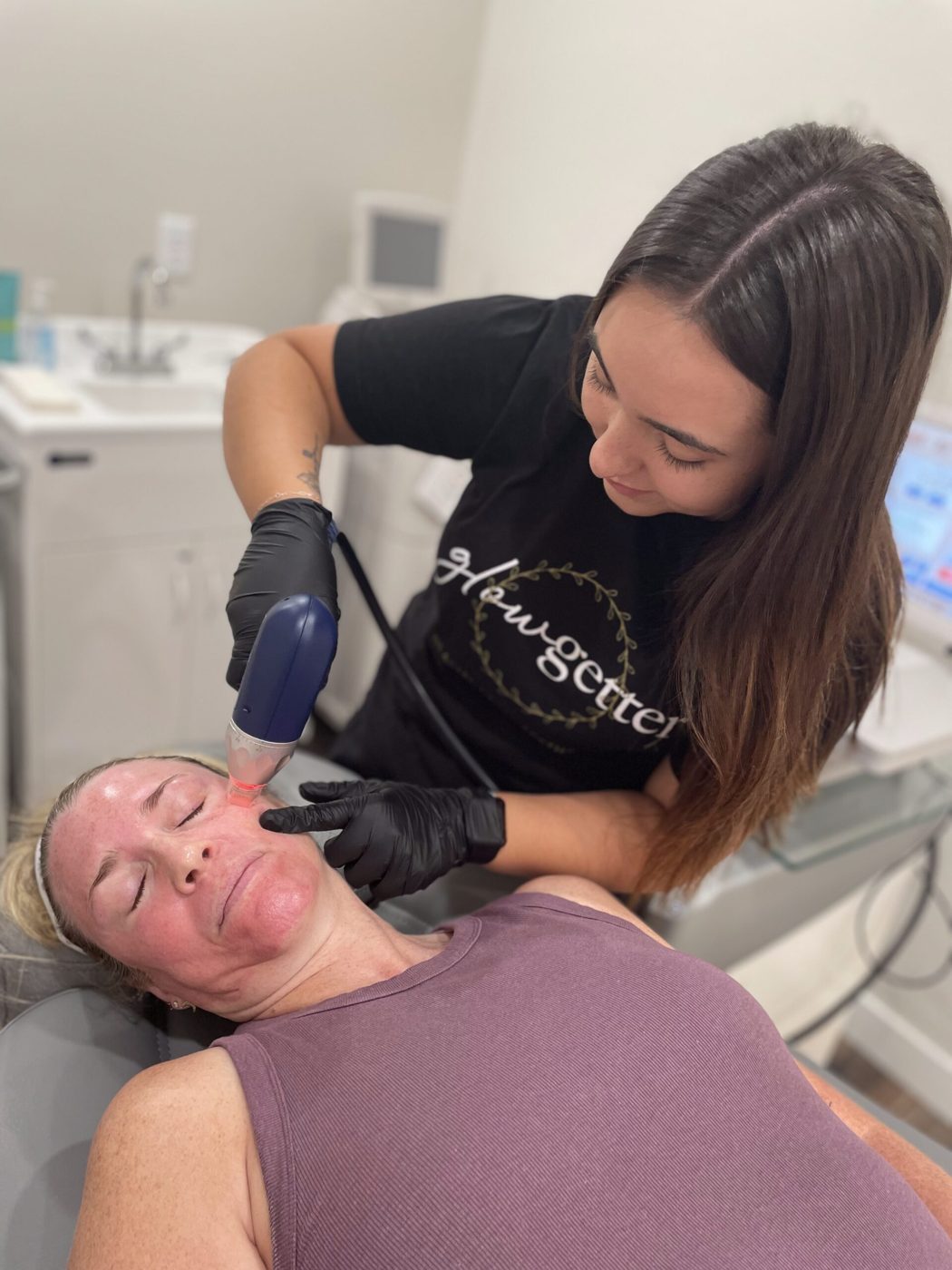 Microneedling and PRP