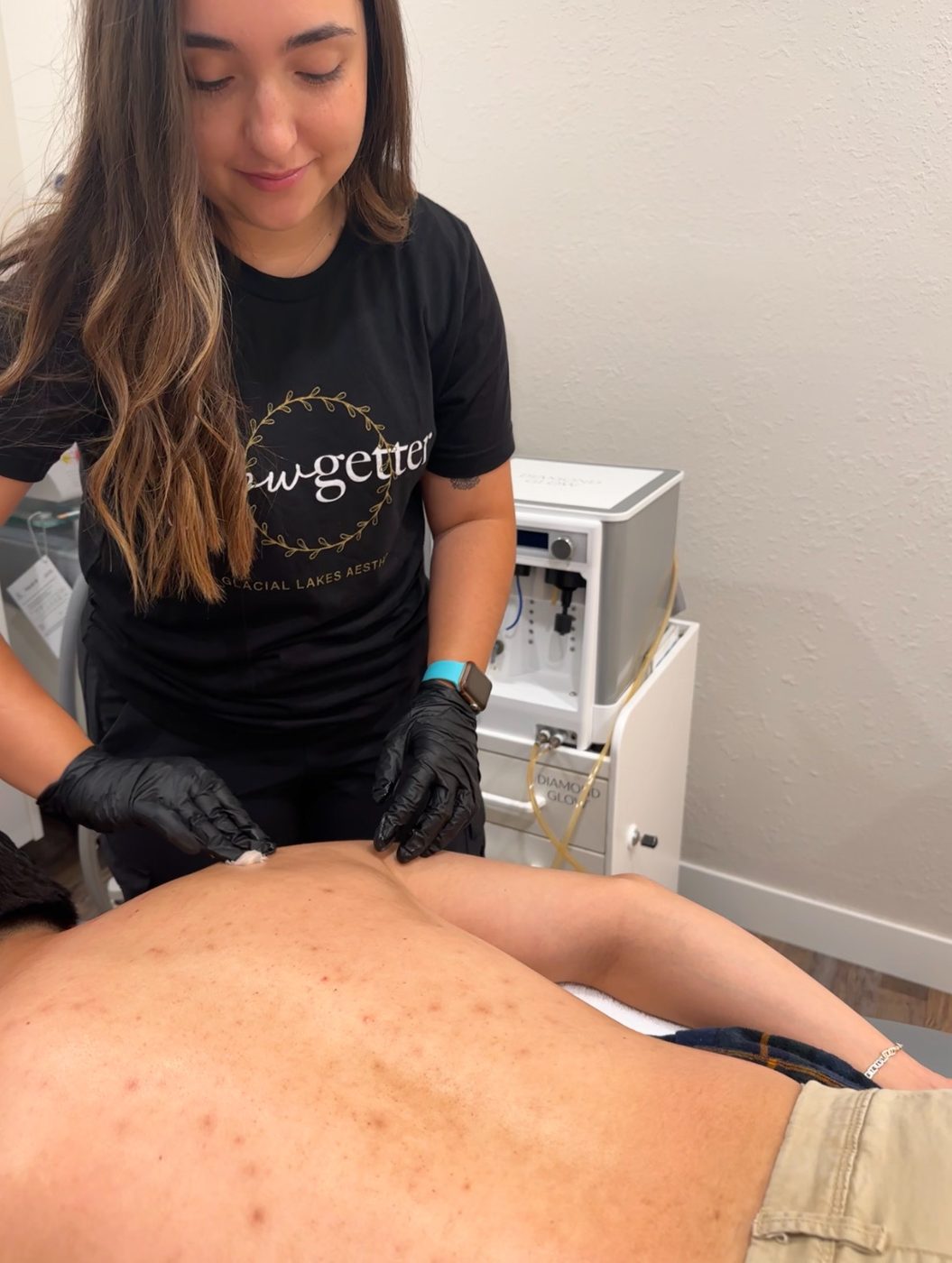 Acne reduction with light and laser at Glacial Lakes Aesthetics in Spicer, Minnesota